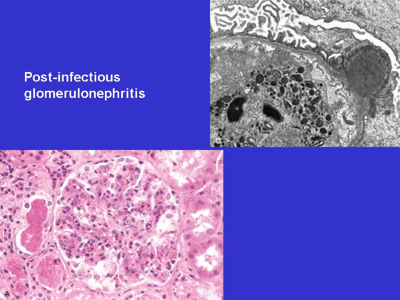 Post-infectious glomerulonephritis